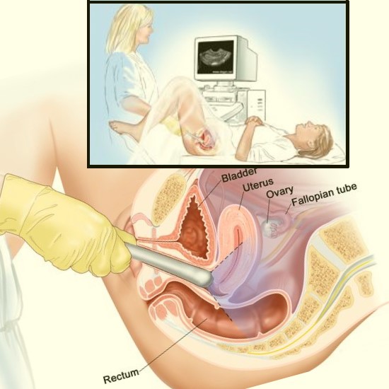 Lower Abdomen Ultrasound